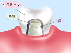 オールセラミック