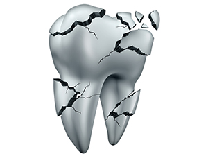 歯の破折の治療に