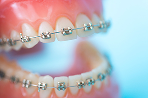 矯正歯科で歯列を整えるメリット