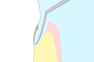 フラップ手術