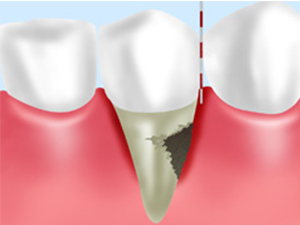 歯周ポケットそうは術