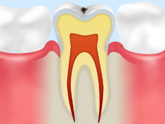 CO：ごく初期のむし歯