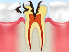 C3：神経のむし歯