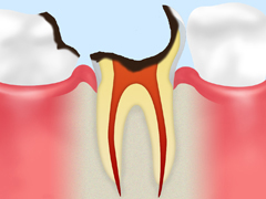 C4：歯根まで達したむし歯